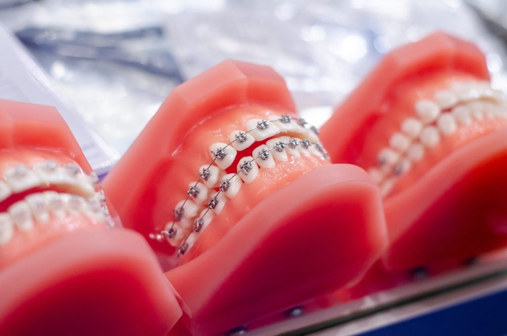 Fast Braces