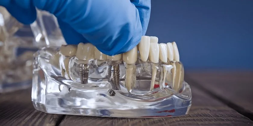 dental implants