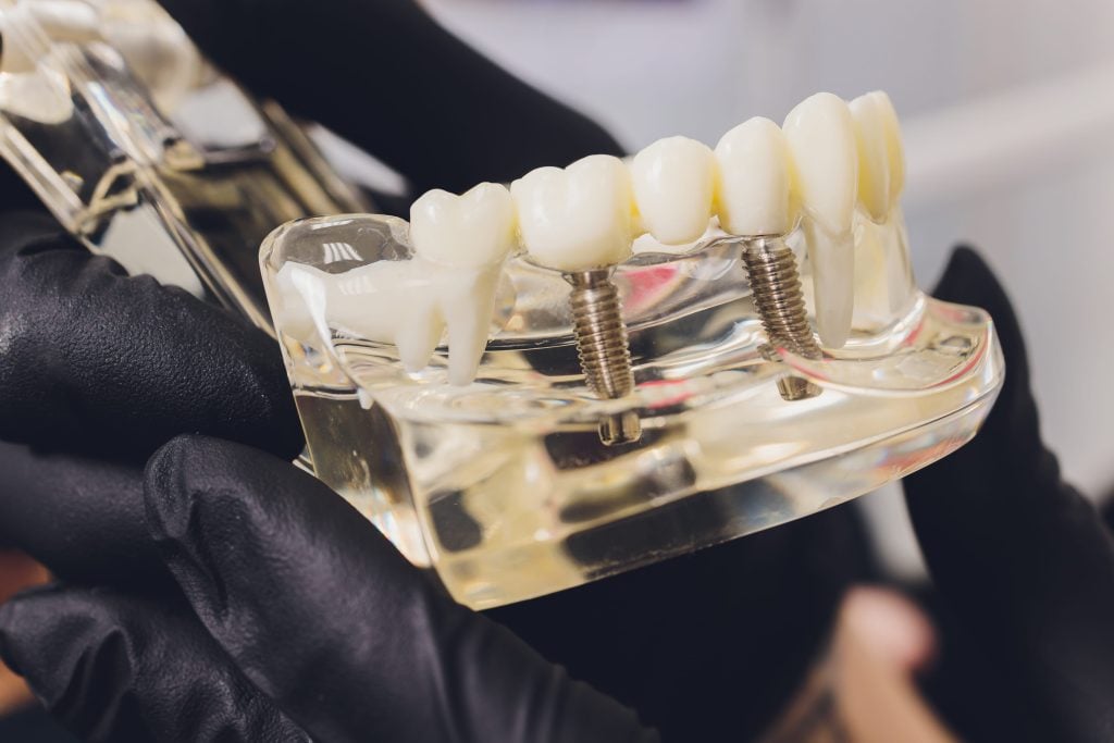 Dental Implants Services