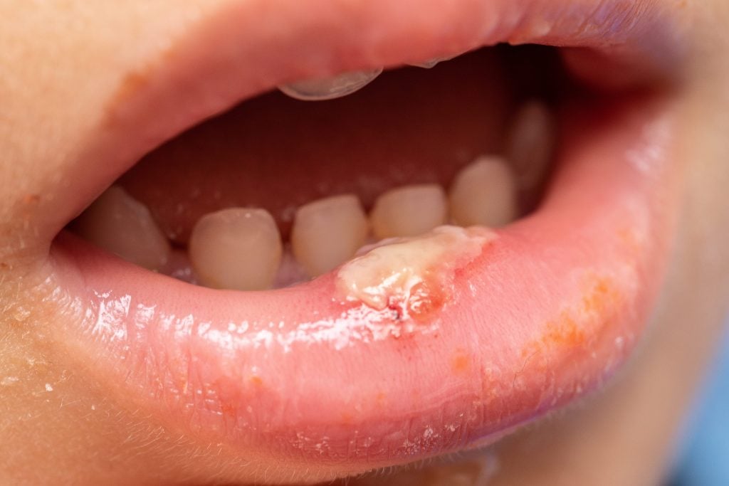 Oral Cancer