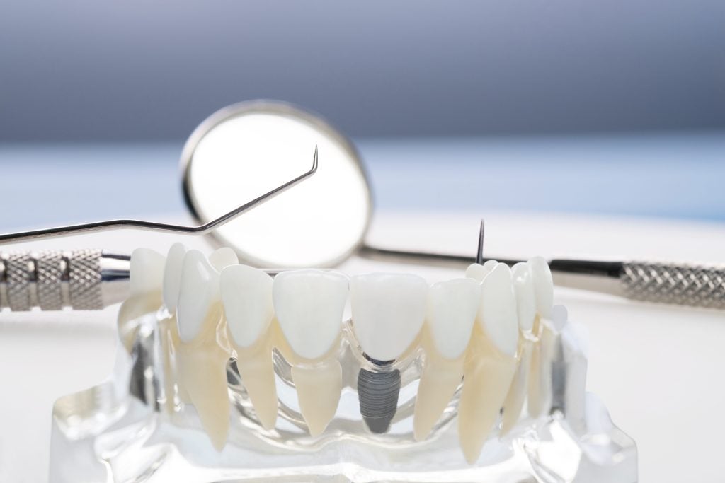 Dental Implant Anxiety