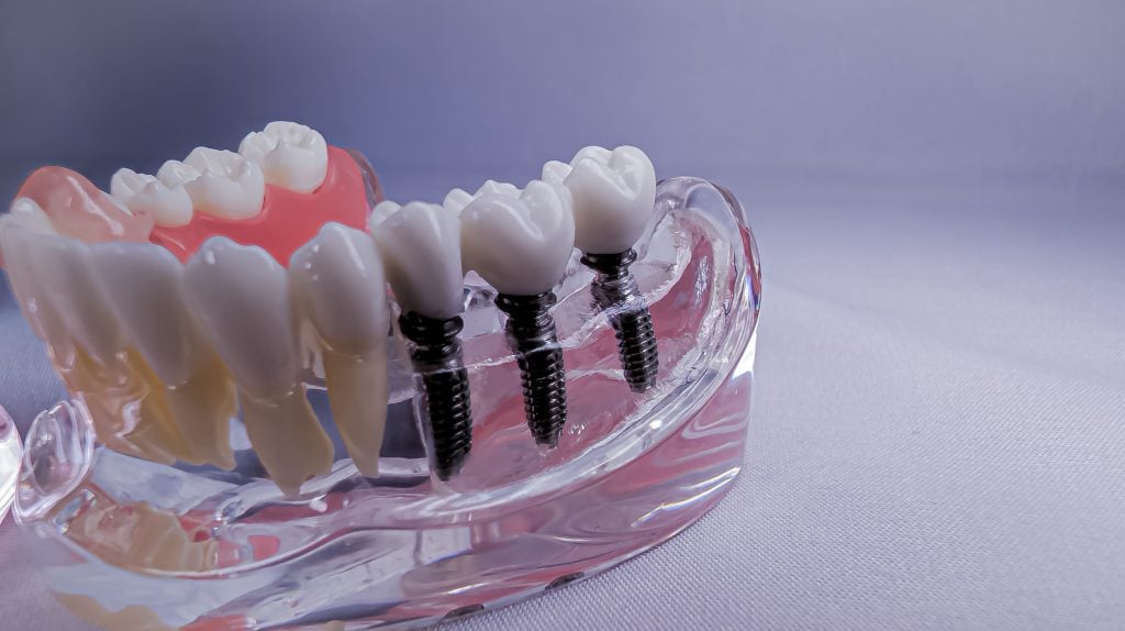 Dental-Implants