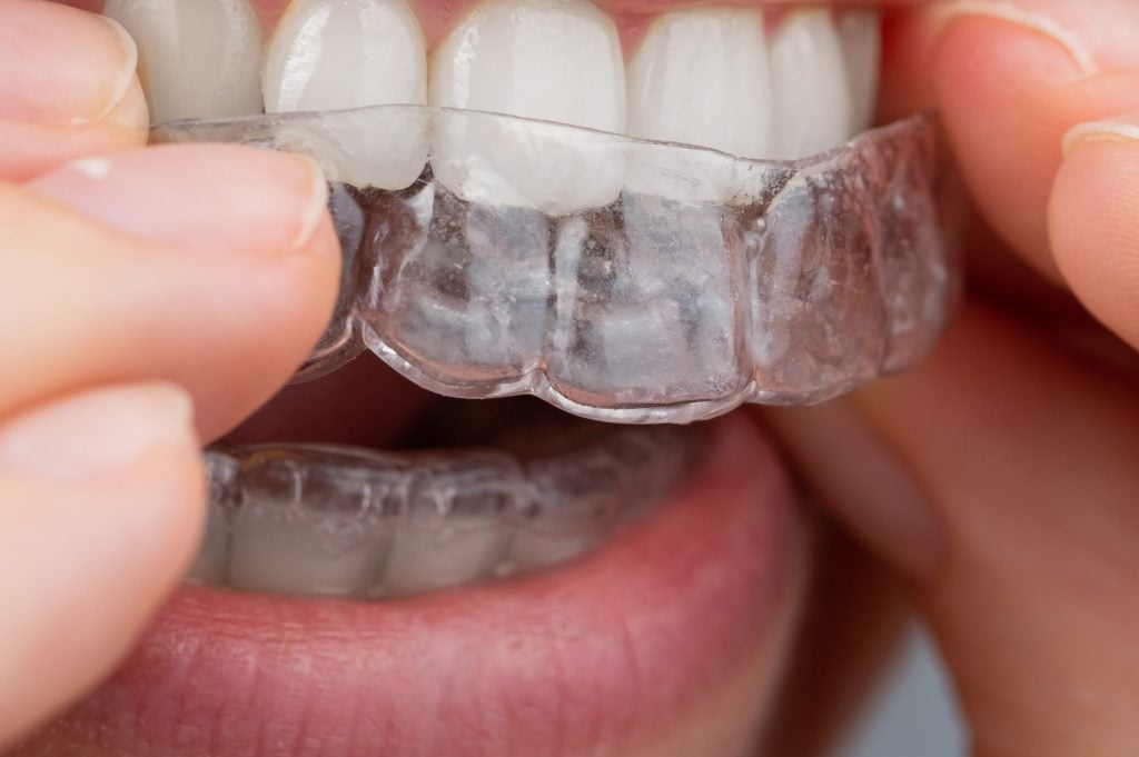 Invisalign Aligners